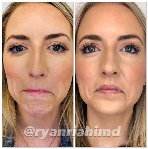 Botox Before And After