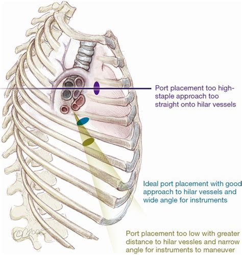 Uniportal Video Assisted Thoracoscopic Lobectomy Sihoe Annals Of Cardiothoracic Surgery