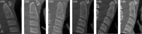 Cervical Vertebrae Maturational Stages Cvm Method A Cs1 B Cs2 C Download Scientific