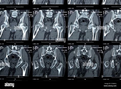 Cairo Egypt November Non Enhanced Ct Scan Of The Pelvis