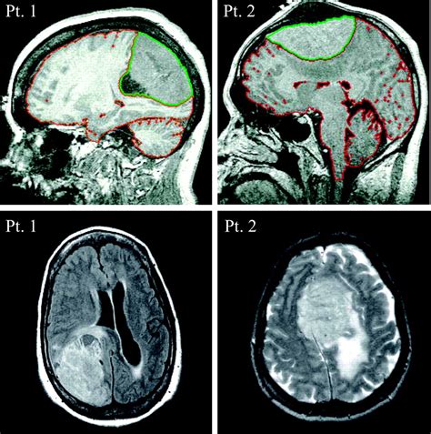 Brain Compression Without Global Neuronal Loss In Meningiomas Whole Brain Proton Mr