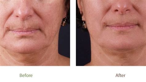 Exilis Face Fat Reduction Hot Sale Varsana