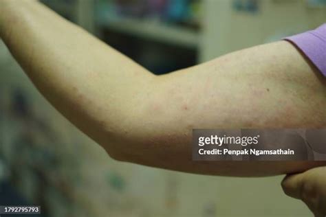 Red Rash Arm Foto E Immagini Stock Getty Images