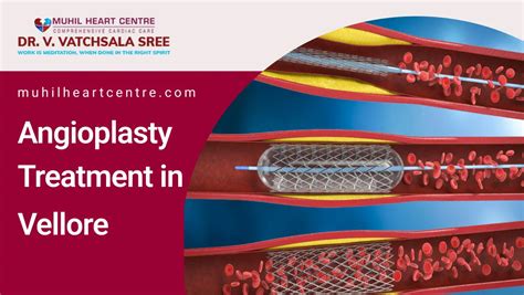 Angioplasty Muhil Heart Centre