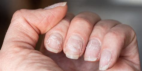 Ridges In Fingernails Symptoms Causes And Treatments 40 Off