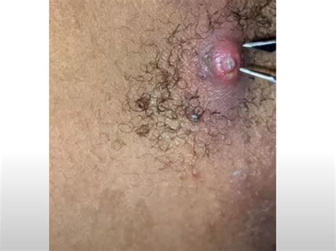 Drainage Of Infected Armpit Lump New Pimple Popping Videos