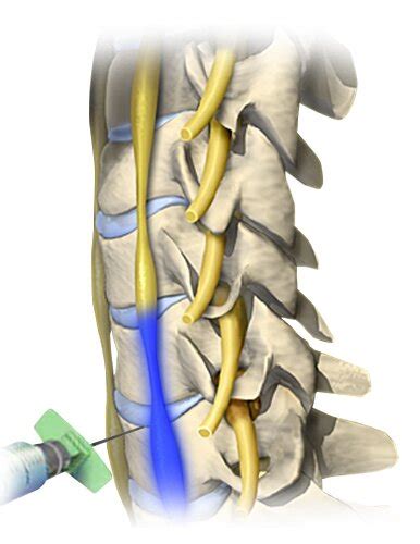 Kentucky Atlas Pain & Spine-Sympathetic Nerve System Blocks