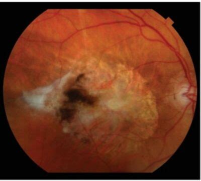 Degeneraci N Macular Concise Medical Knowledge