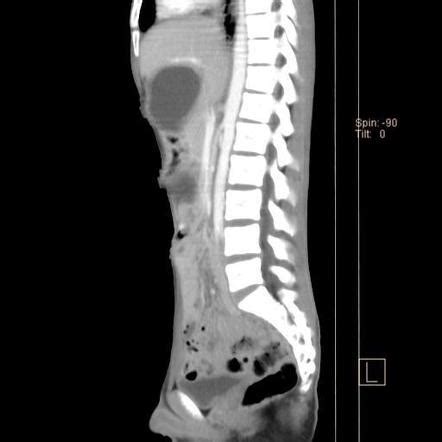 Scaphoid abdomen | Radiology Reference Article | Radiopaedia.org