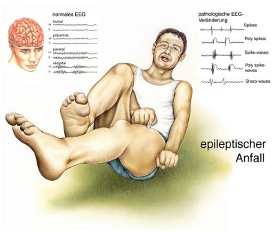 Epilepsie Ursachen Symptome Behandlung Medlexi De