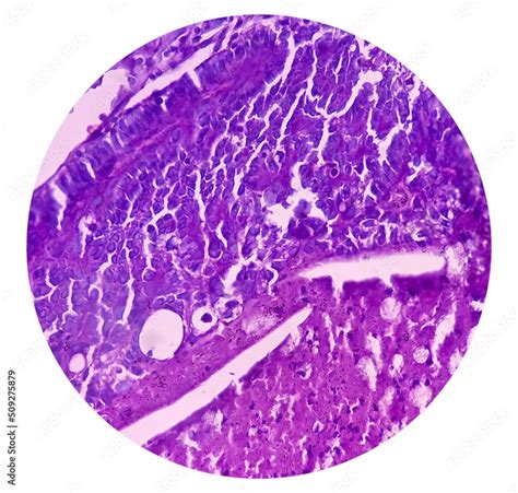 Intra Cranial Space Occupying Lesionbiopsy Brain Cancer Metastatic