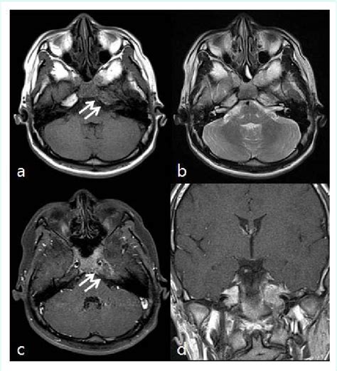 [PDF] Headache Attributed to Petrous Apicitis without Symptoms of Acute ...