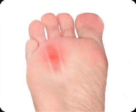 Signs And Symptoms Of Mortons Neuroma