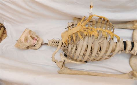 School Discovers Their Model Skeleton Is Actually A Real Dead Person