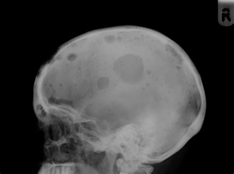 Bone Tumours And Benign Lytic Lesions