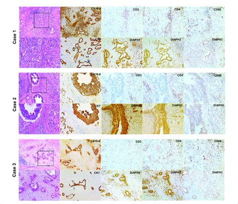 H E And Ihc Staining Of Human Pancreatic Ductal Adenocarcinoma H E