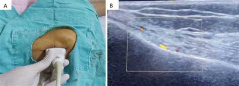 Ultrasonography And Fluoroscopy Guided Technique For Cooled Radiofrequency Ablation Of The