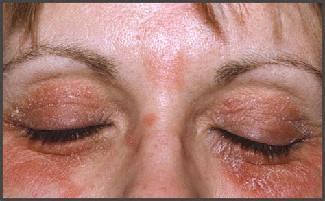 psoriasis around eyes pictures | Psoriasis expert