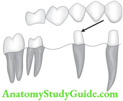 Partial Denture Short Essay On Pier Abutment Question And Answers ...