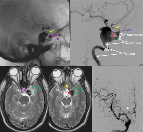 Internal Carotid Artery And Its Aneurysms