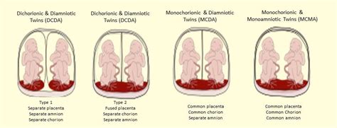 What Is Twin Zygosity Understanding Different Types Of