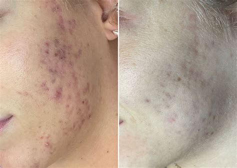 Skinpen Microneedling Photos Houston Tx Patient