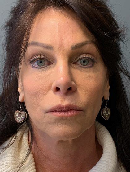 Patient Deep Plane Facelift Before And After Photos Calhoun Ga