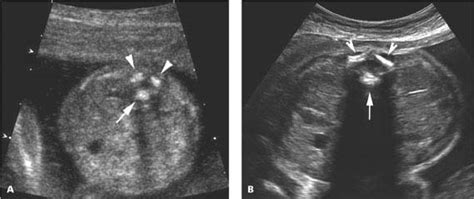 Second and Third Trimester Fetal Anatomy | Radiology Key