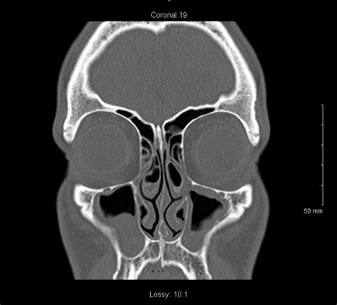 Practical Techniques In Office Based Balloon Sinus Dilation Operative