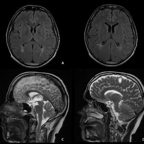 A B Axial Cross Section Mri Images Of The Brain On Flair Sequence