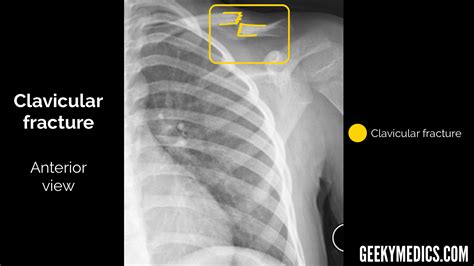 Clavicle Anatomy Xray