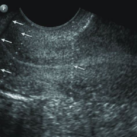 Colposcopy Erosion Of The Cervix With Dysplasia Cin I Lugol S