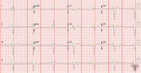 Paced Rhythms | ECG Stampede