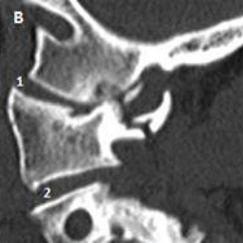 Cervical Spine Ct Scan A Widening And Slight Anterior Subluxation Of