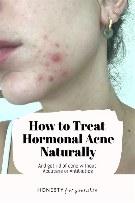 Your Best Hormonal Acne Skincare Routine Artofit