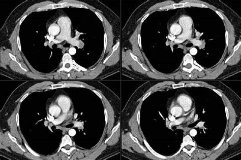 Pulmonary Roundtable: Abnormal CT scan