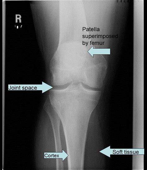 Radiography Knee Injury And Prevention