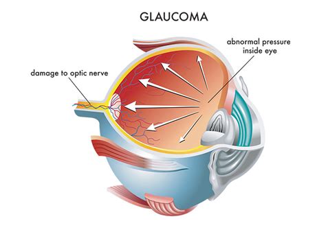 Sacramento Glaucoma Doctor California Lasik Eye