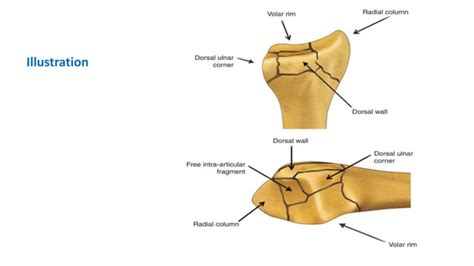 Complex Distal Radius Fracture Dr Azanki Ppt