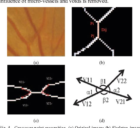 Figure 4 from Automatic detection of arteriovenous nicking in retinal ...