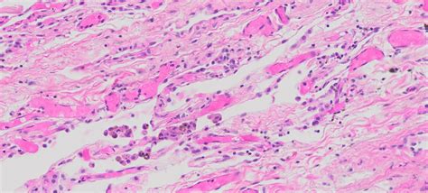 Human Lung Adenocarcinoma Normal Matched Pair Tissue Ffpe Sections