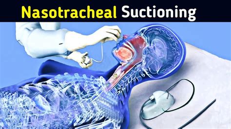 How Nasotracheal Suction Is Performed YouTube