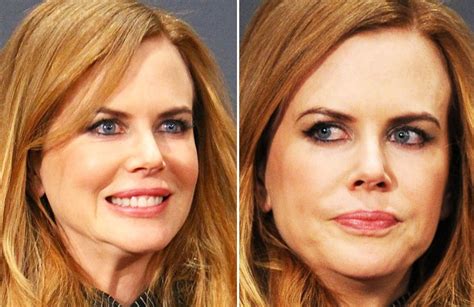 Nicole Kidman Before And After Plastic Surgery