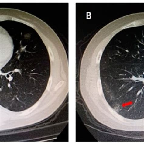 Multiple Patchy Glass Ground Opacities In Bilateral Subpleural Areas Download Scientific