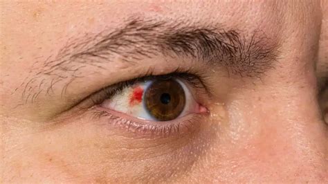 Acanthamoeba Keratitis Symptoms Causes And Treatment Options