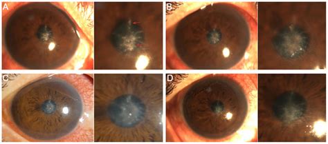 Localized Lesions Before And After Surgery In The Corneal Cross Linking