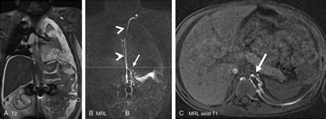 Lymphatic Ducts And Disorders Radiology Key