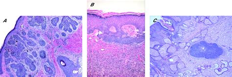 Skin Adnexal Neoplasms—part 1 An Approach To Tumours Of The