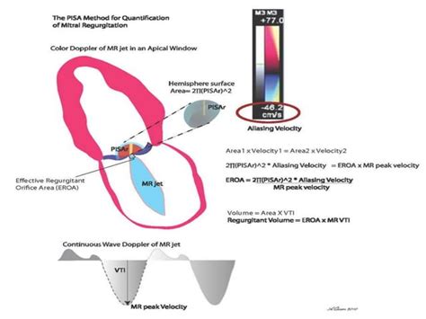 Echocardiographic Evaluation Of Mitral Regurgitation PPT