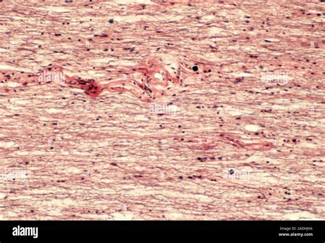 Multiple sclerosis. Light micrograph of a section through human spinal ...